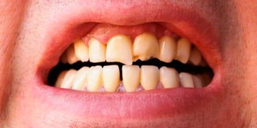 сонник сломался зуб